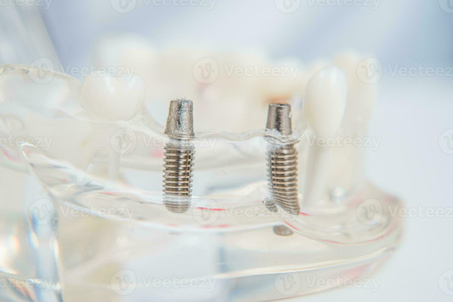 A model of teeth with implants lies on a table photo