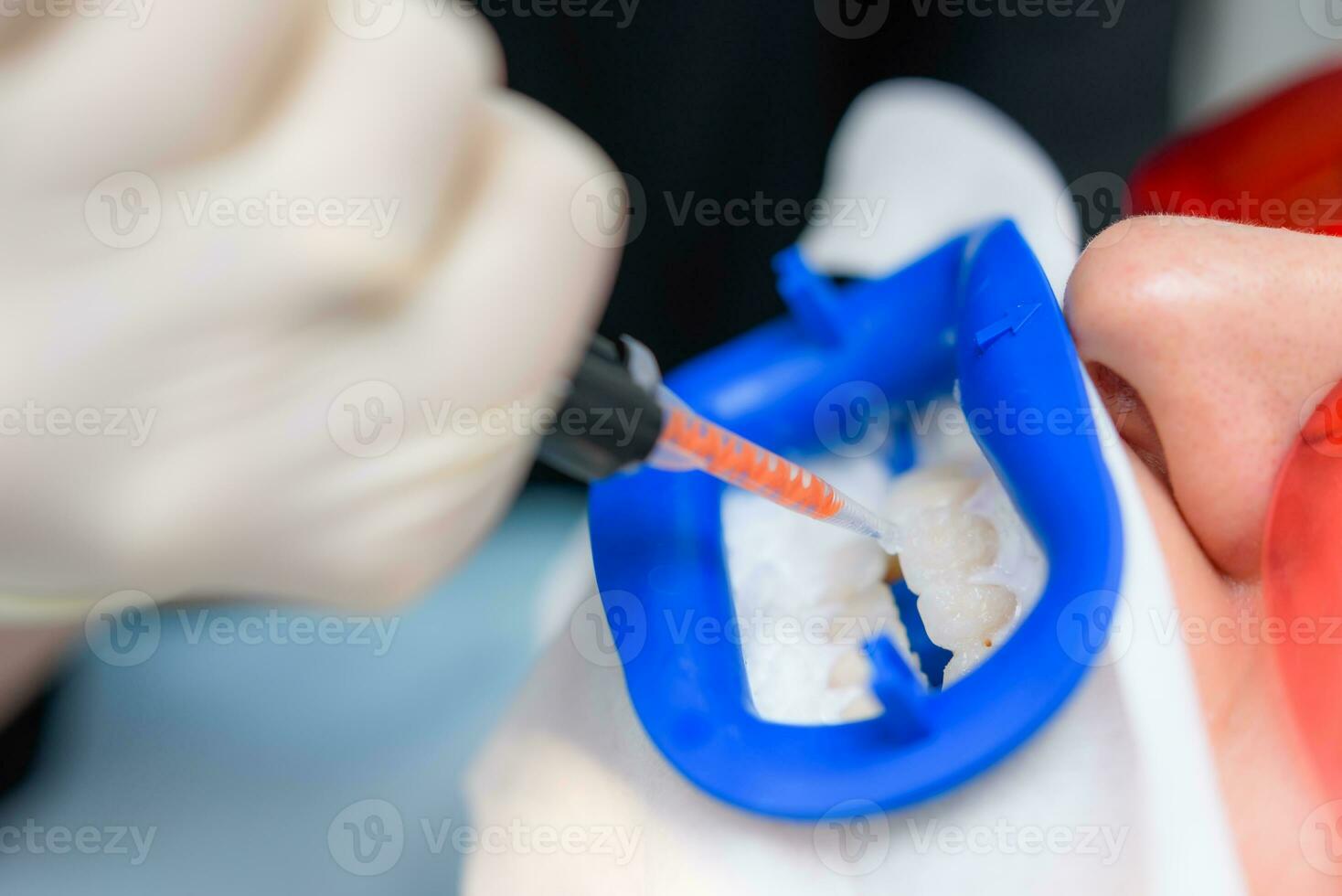 preparando el oral cavidad para blanqueo con un ultravioleta lámpara. de cerca foto