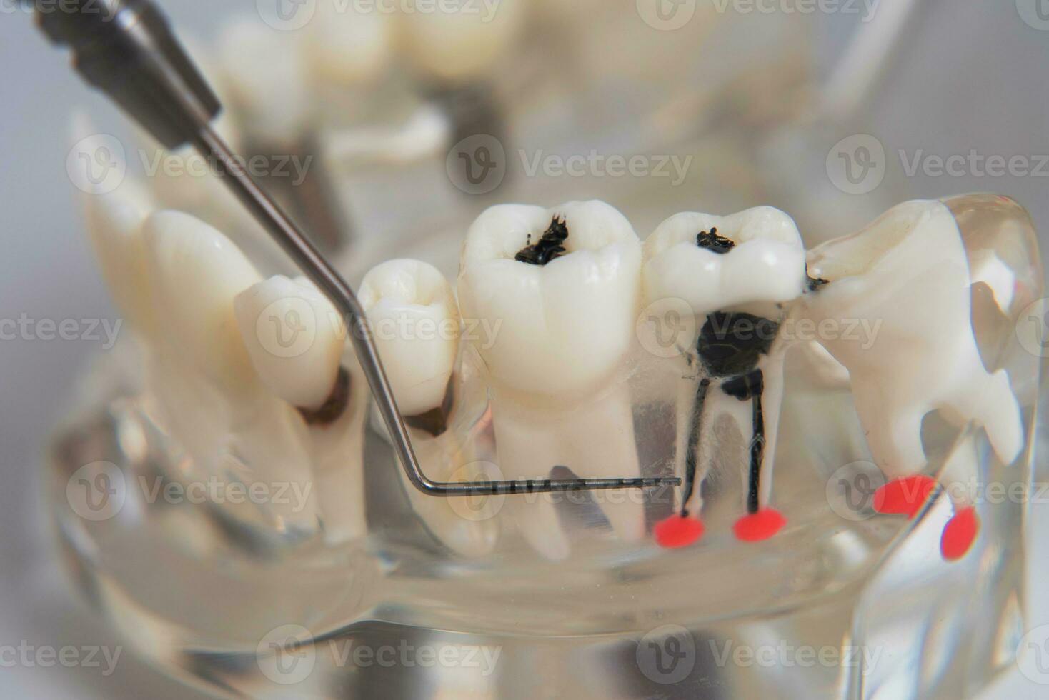 médico ortodoncista muestra el instrumento en caries en el dientes foto