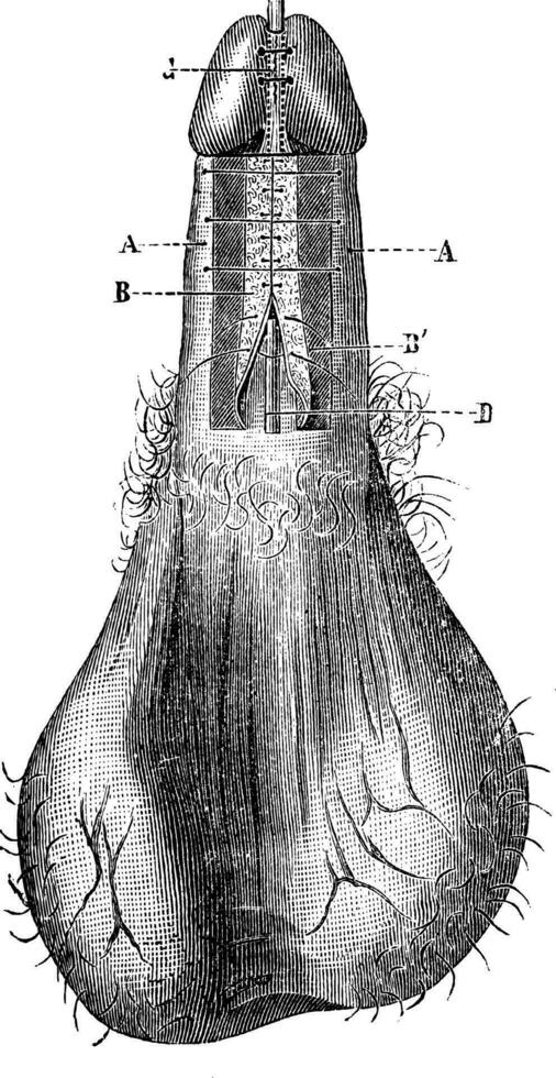 Operation of hypospadias Process for the Duplay vintage engraving. vector