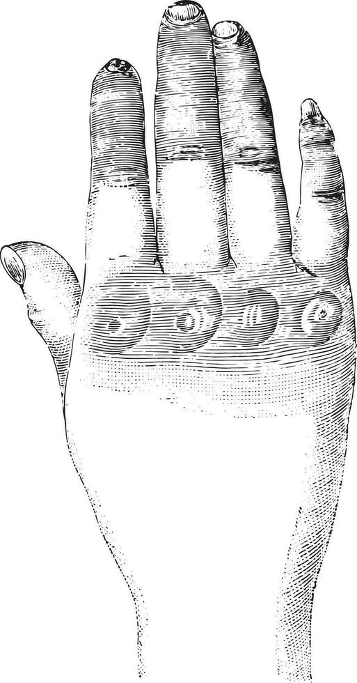 Sclerosis of the left hand dorsal, vintage engraving. vector