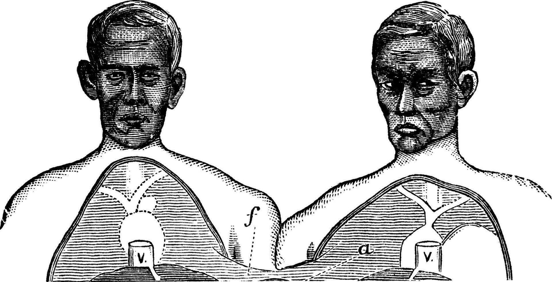 Siamese twins. V. Vena cava. f. Upper limit of the common axis, vintage engraving. vector