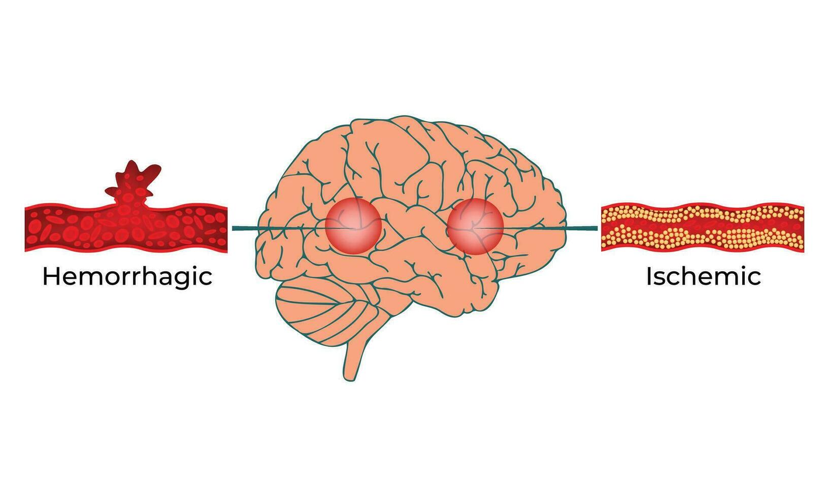 hemorrágico isquémico Ciencias diseño vector ilustración diagrama
