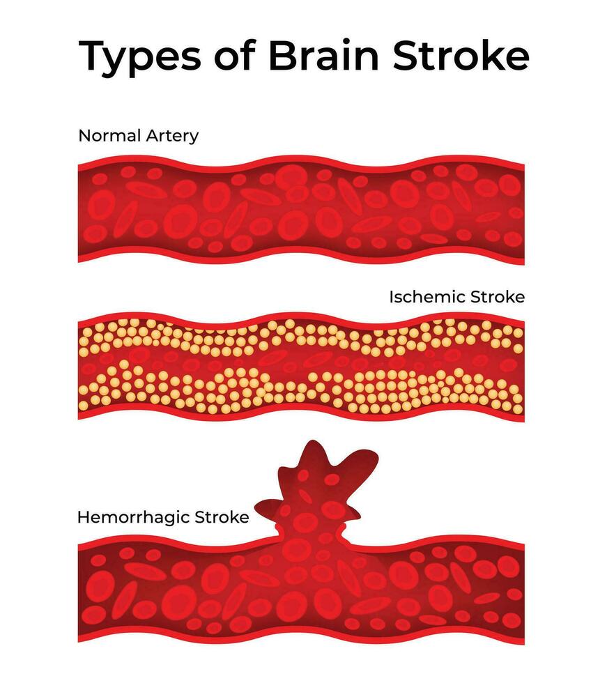 Type of Brain Stoke Science Design Vector Illustration Diagram