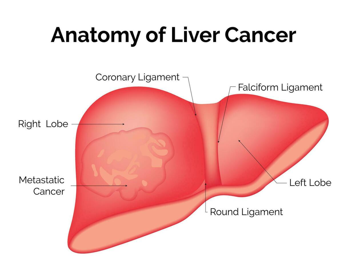 anatomía de hígado cáncer Ciencias diseño vector ilustración