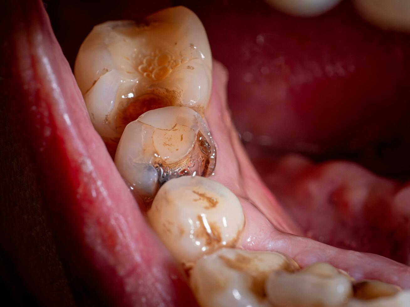 diente decadencia, roto dientes, oral salud pobre dental salud. oral salud problemas. perder, amarillo dientes, placa y sarro a el borde de el cena foto
