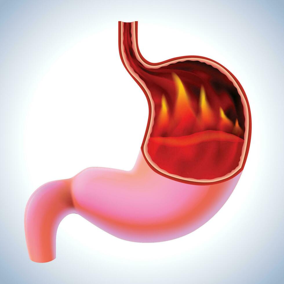 3D illustration of a stomach with flames burning inside is a sign of burning pain, a symptom of gastritis. vector
