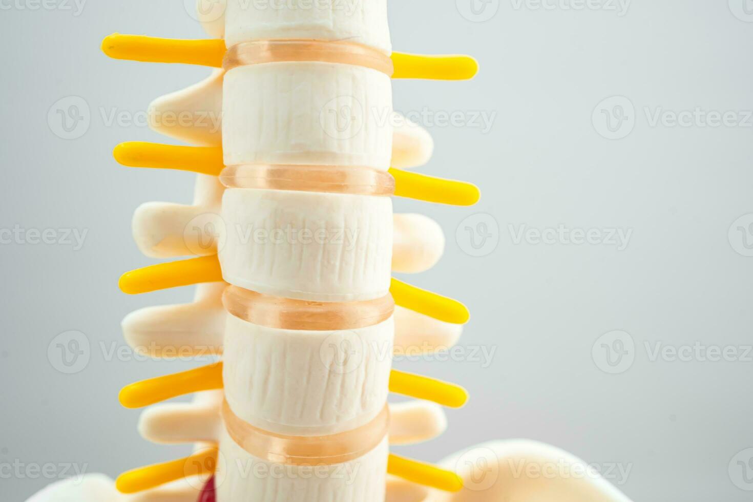 Lumbar spine displaced herniated disc fragment, spinal nerve and bone. Model for treatment medical in the orthopedic department. photo