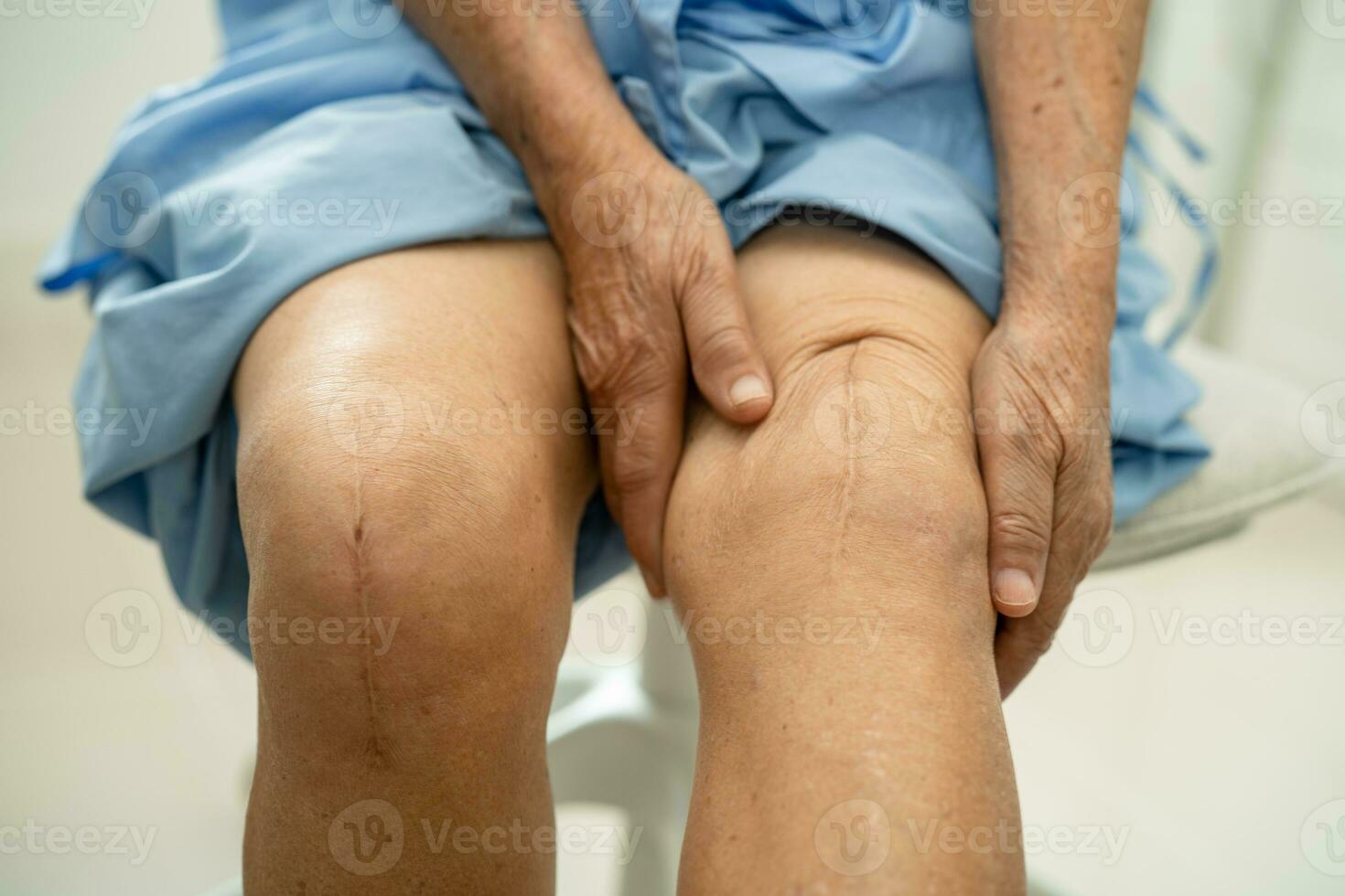 Asian elderly woman patient show her scars surgical total knee joint replacement Suture wound surgery arthroplasty on bed in hospital. photo