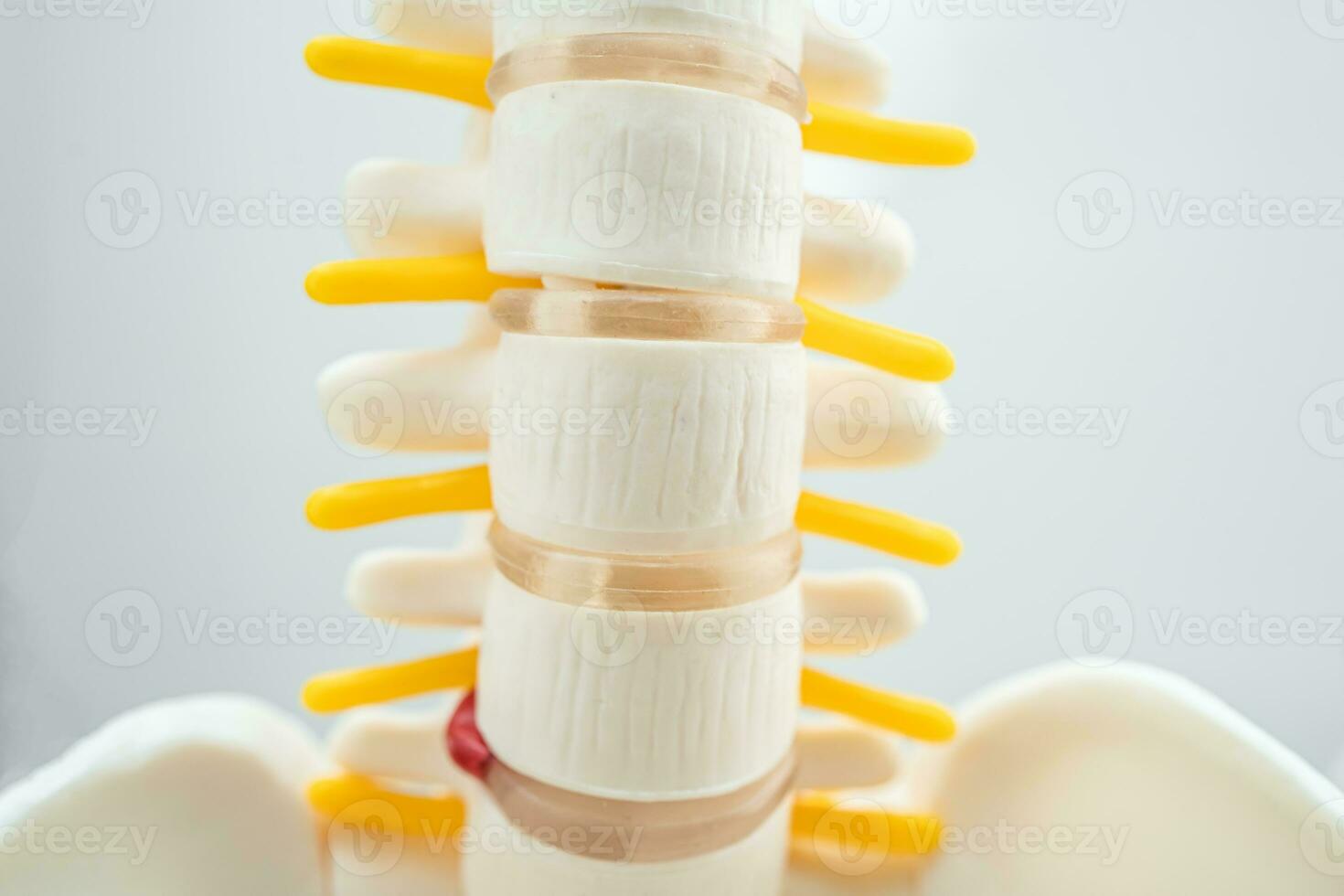 Lumbar spine displaced herniated disc fragment, spinal nerve and bone. Model for treatment medical in the orthopedic department. photo