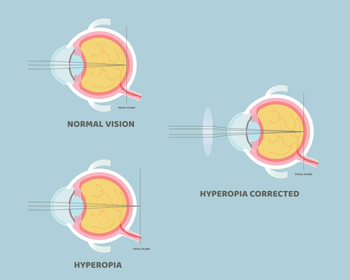 eyeball anatomy, internal organs body part nervous system, hyperopia concept, vector illustration cartoon flat design clip art