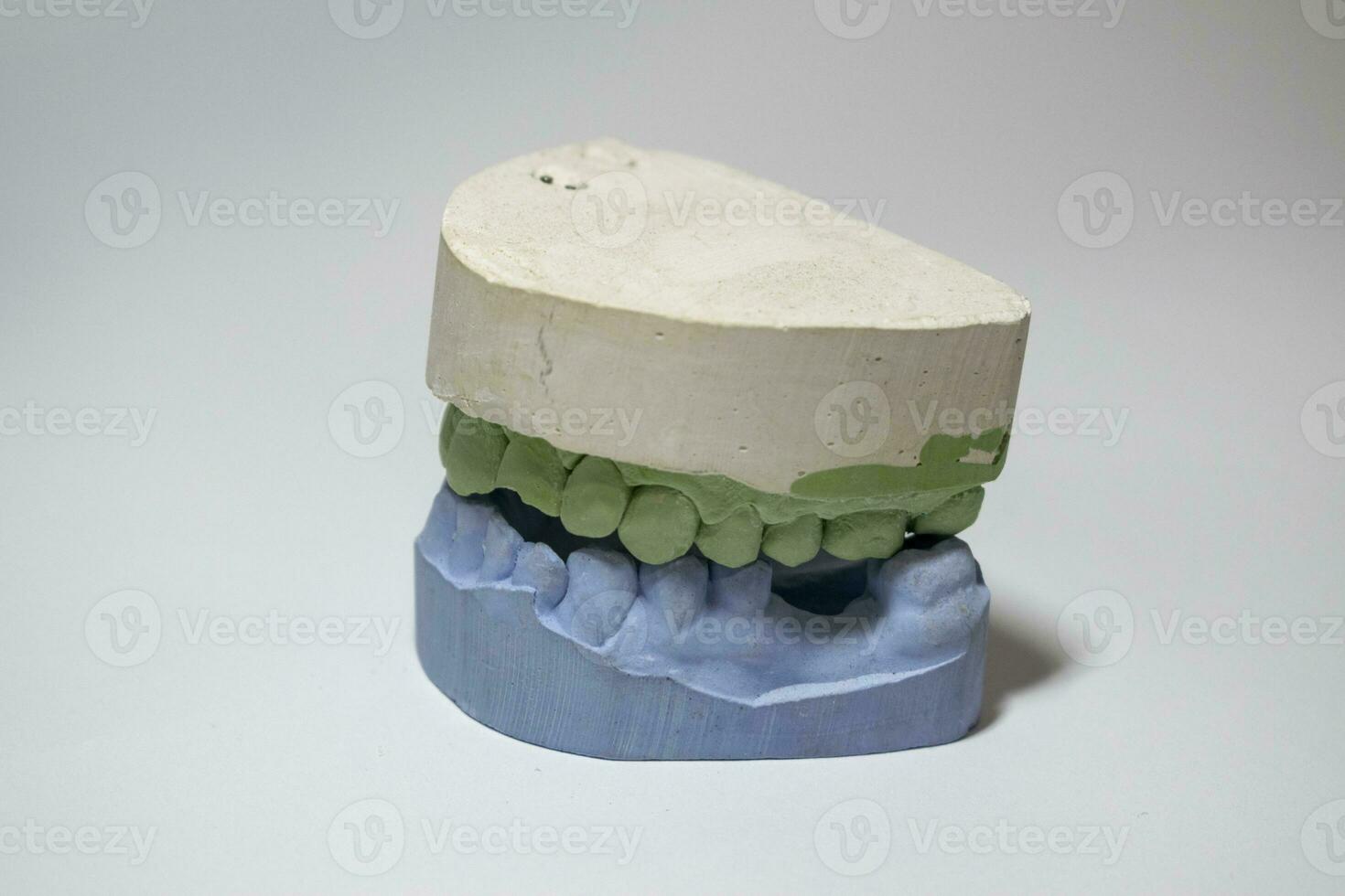 Plaster impressions of the teeth of the lower and upper jaws for prosthetics and photo