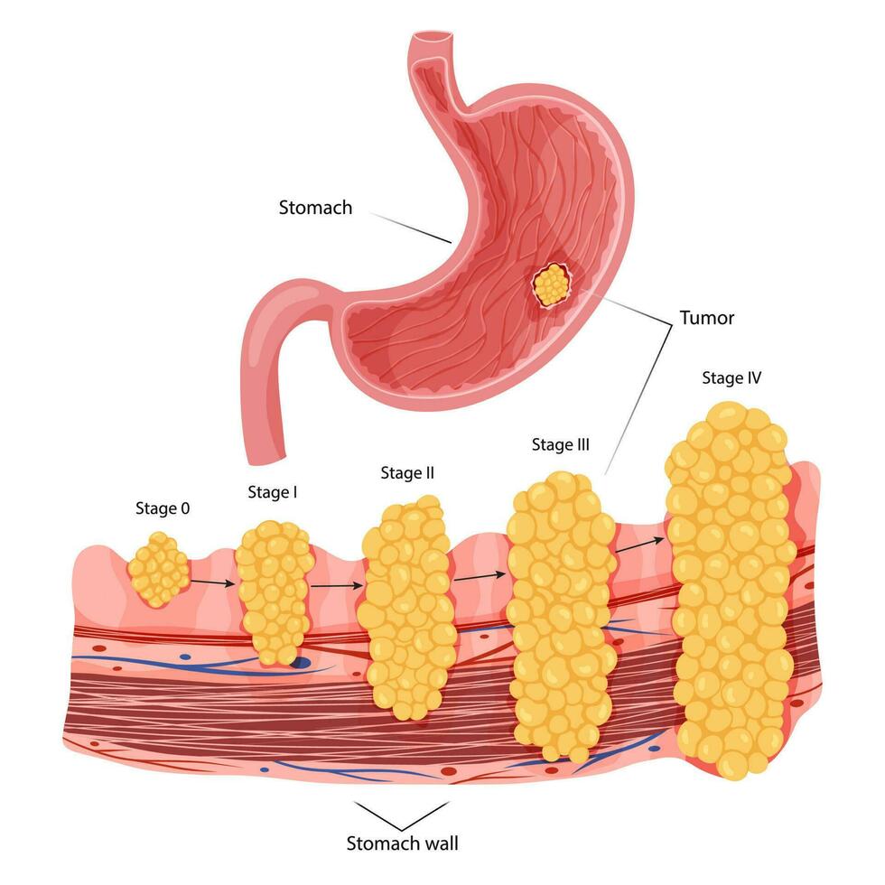 estómago cáncer. etapas crecimiento maligno canceroso tumor. anatómico vector ilustración aislado blanco antecedentes dibujos animados estilo