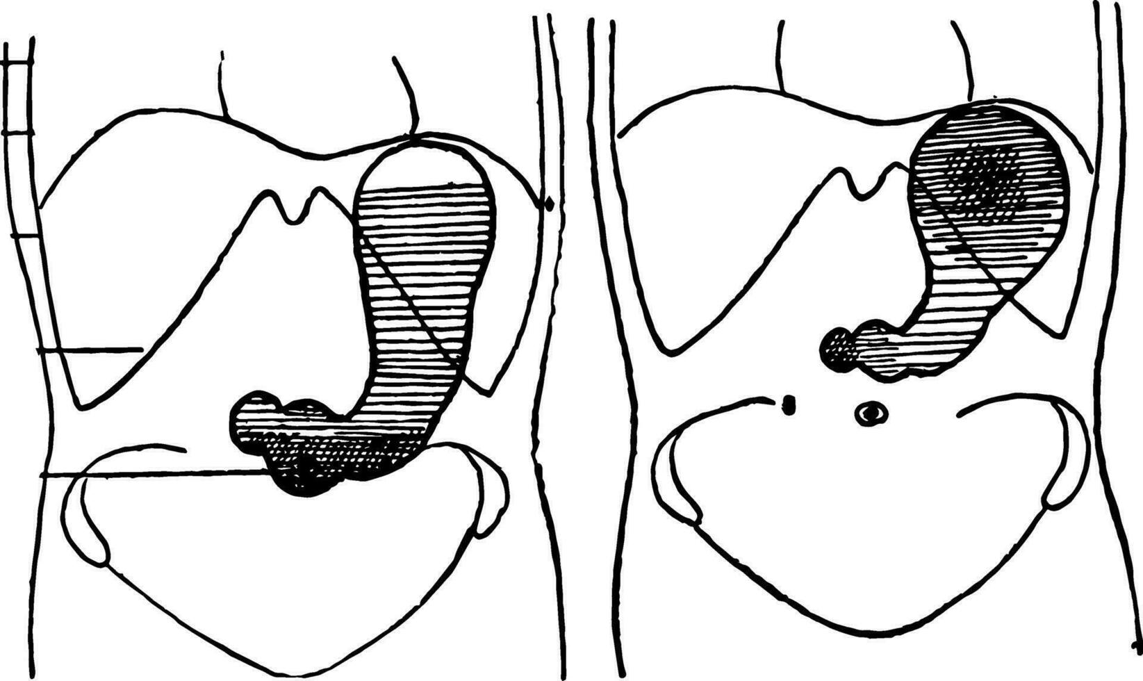 Stomach in a Bismuth-Laden Diet, vintage illustration. vector