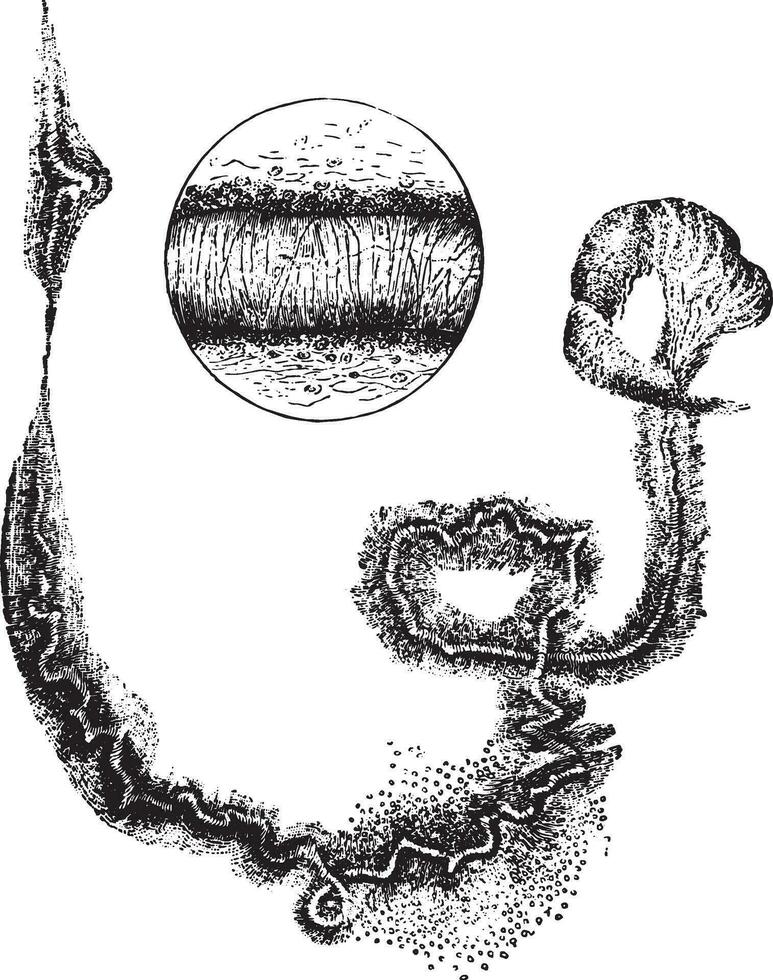 Curschmann's spirals, vintage engraving. vector