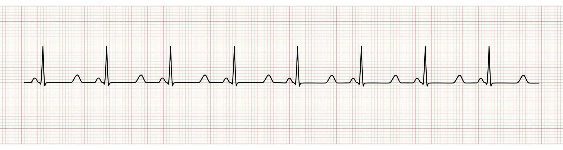 EKG Monitor Showing  Sinus Rhythm with prolong QT interval vector