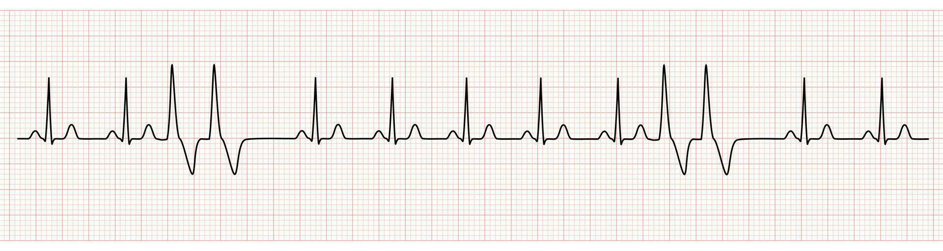 EKG Monitor Showing  Sinus Rhythm with Couplets PVC vector