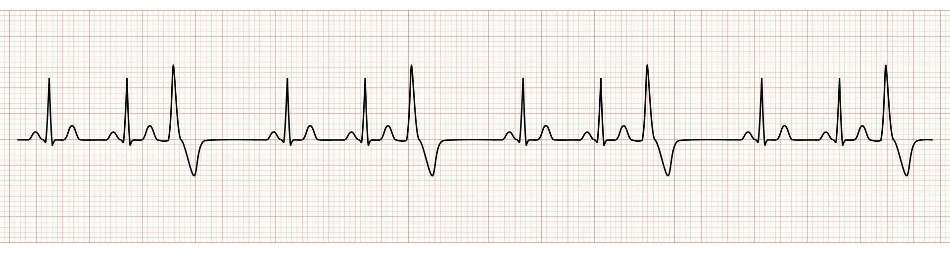 EKG Monitor Showing  Sinus Rhythm with Trigeminy PVC vector