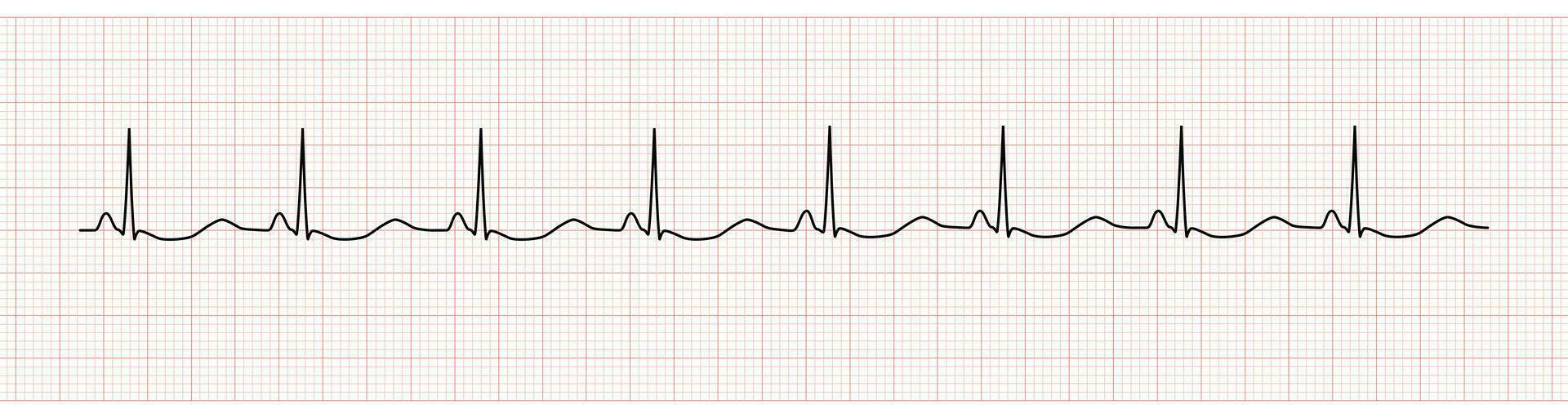 EKG Monitor Showing  Sinus Rhythm with U wave represented Hypokalemia vector