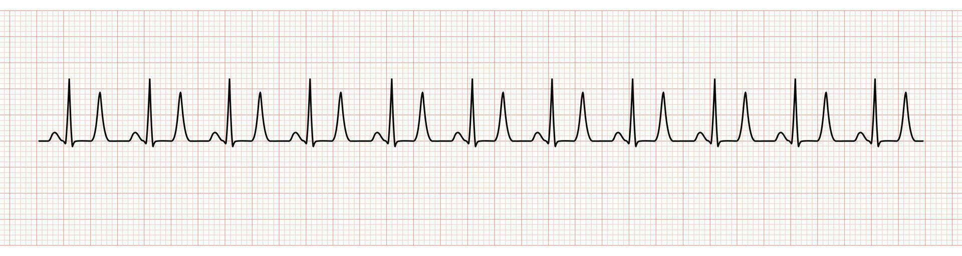 EKG Monitor Showing  Sinus Rhythm with Tall T Wave Represented Hyperkalemia vector