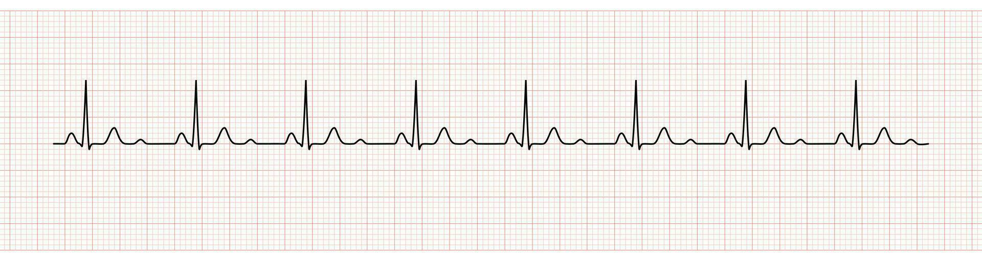 EKG Monitor Showing  Sinus Rhythm with U wave represented Hypokalemia vector