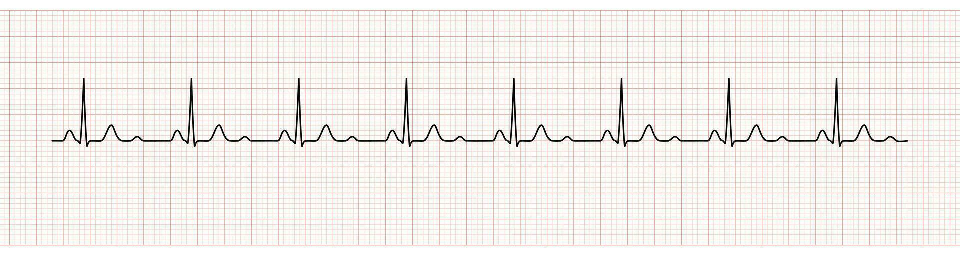 EKG Monitor Showing  Sinus Rhythm with U wave represented Hypokalemia vector