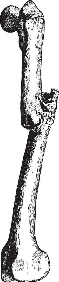 Fracture of the femur, vintage engraving. vector