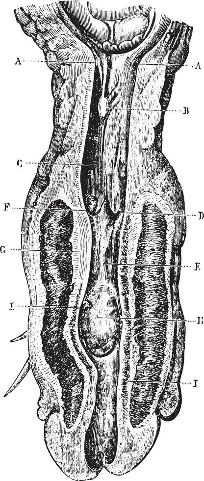 Channel narrowing of the urethra reaches of pockets and urethral vector