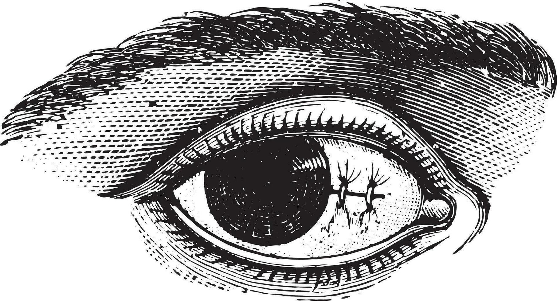 Suture of the conjunctiva after excision of pterygium, vintage e vector