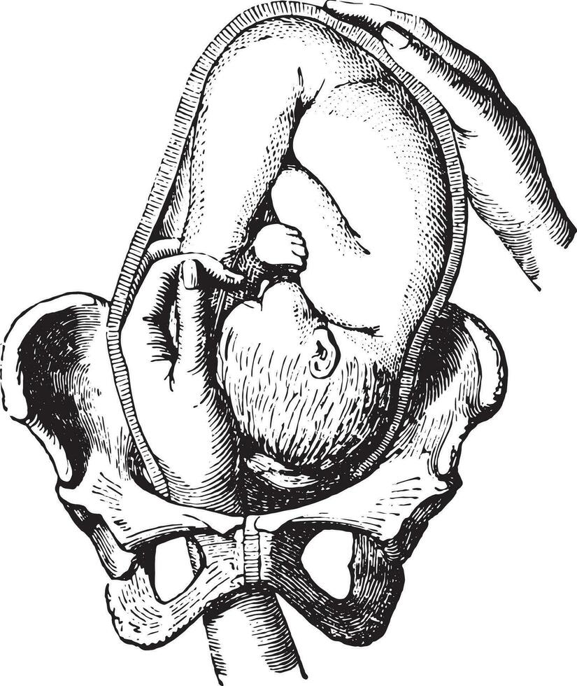 External cephalic version, vintage engraving. vector