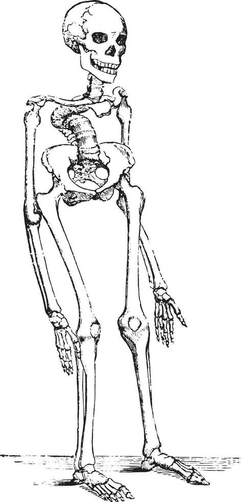 Skeleton deformed by rickets which deflected the spinal column, vintage engraving. vector