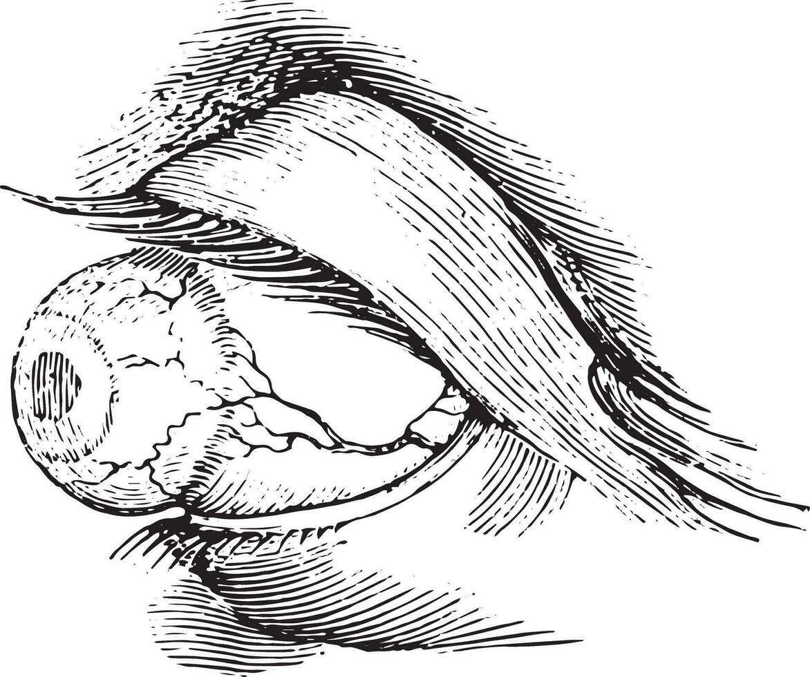 Total anterior staphyloma, vintage engraving. vector