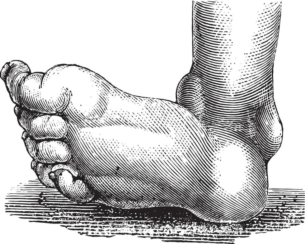 Clubfoot or congenital talipes equinovarus, vintage engraving. vector