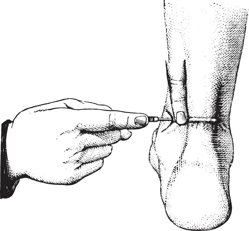 Tenotomy of the Achilles tendon, vintage engraving. vector