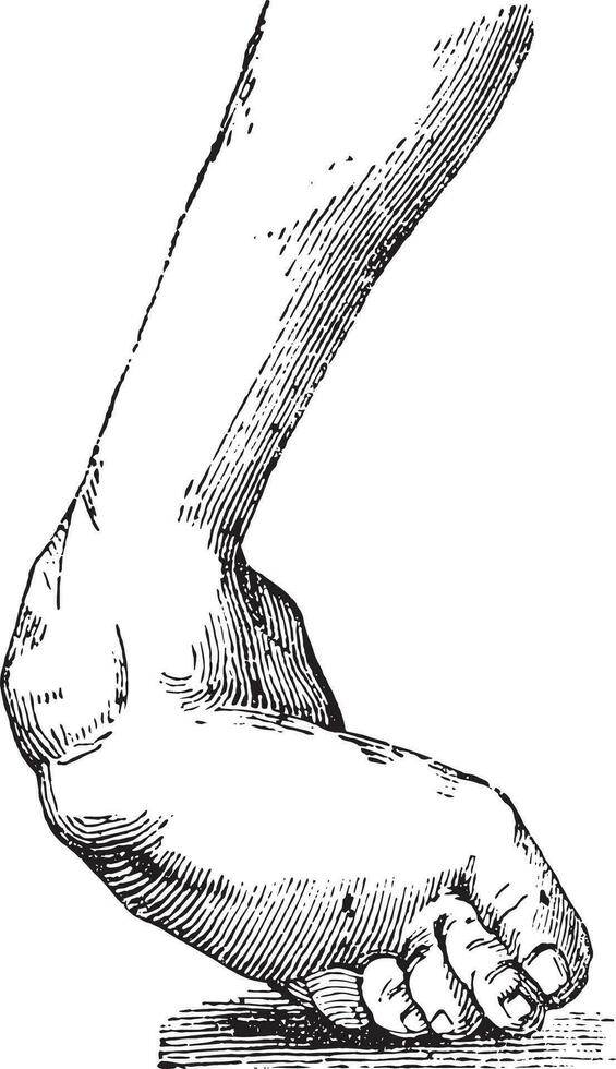 Clubfoot associated with equine varus, vintage engraving. vector