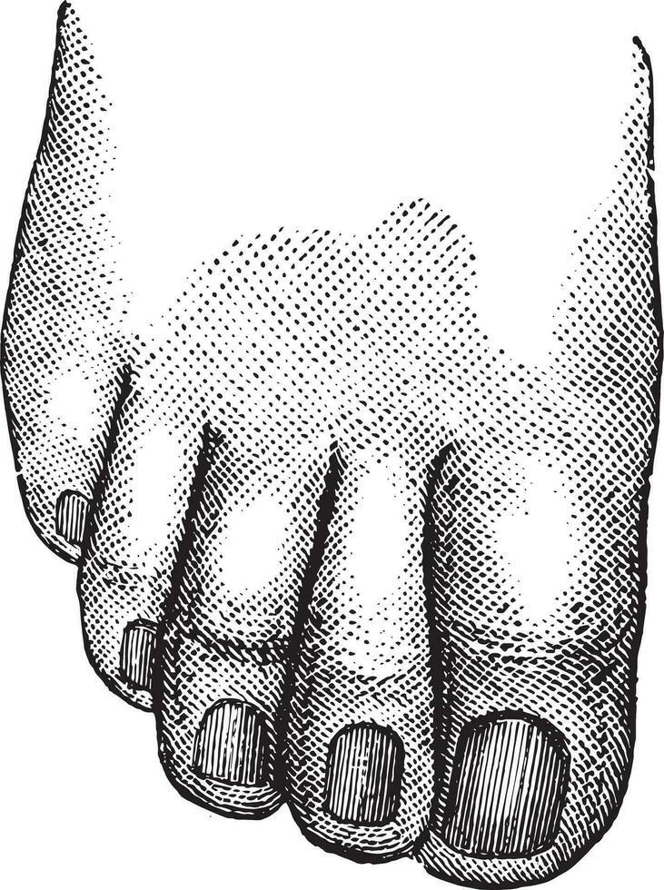 Faulty position of the big and second toe, vintage engraving. vector