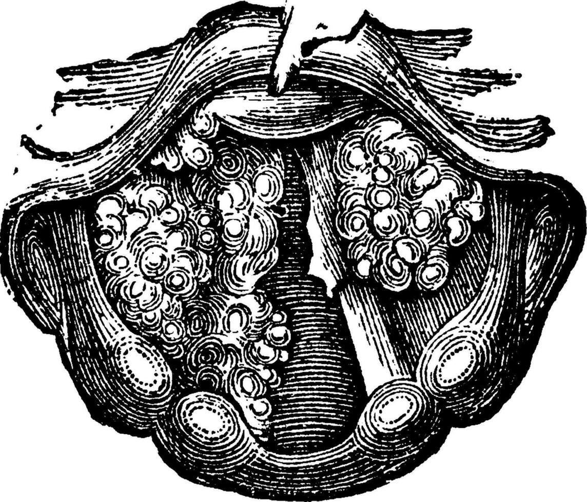 Multiple Papilloma of the Larynx, vintage engraving vector