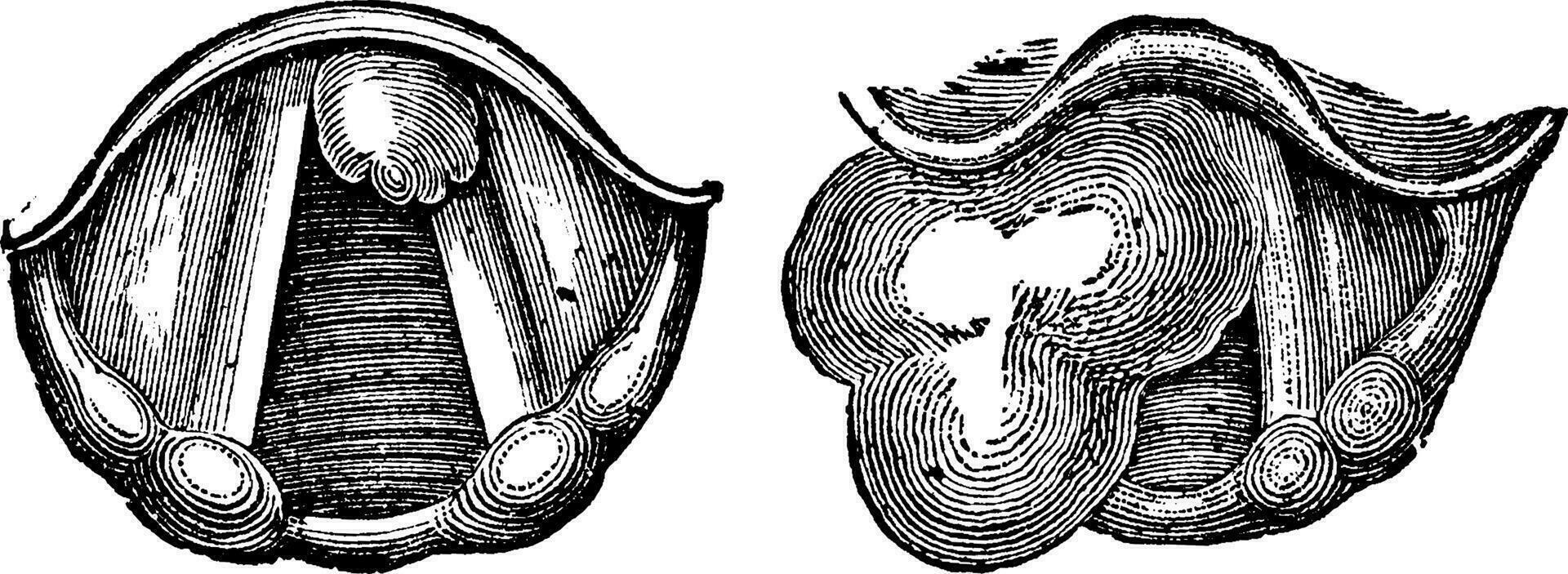 Fibroids of the Larynx, vintage engraving vector