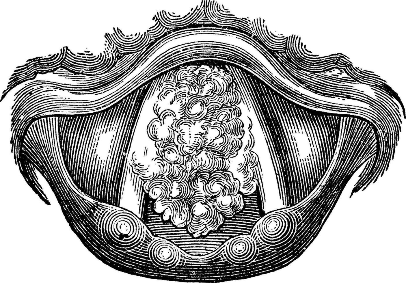Myxoma of the Larynx, vintage engraving vector