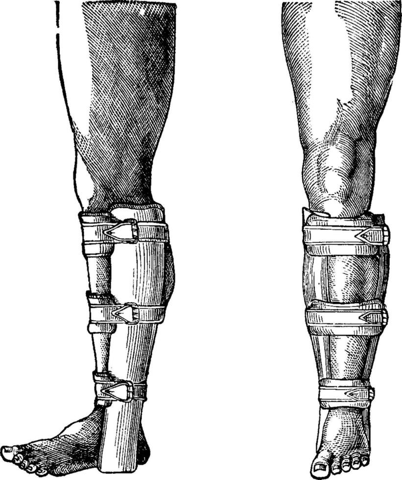 Splint Applied to a Fractured Leg, vintage engraving vector
