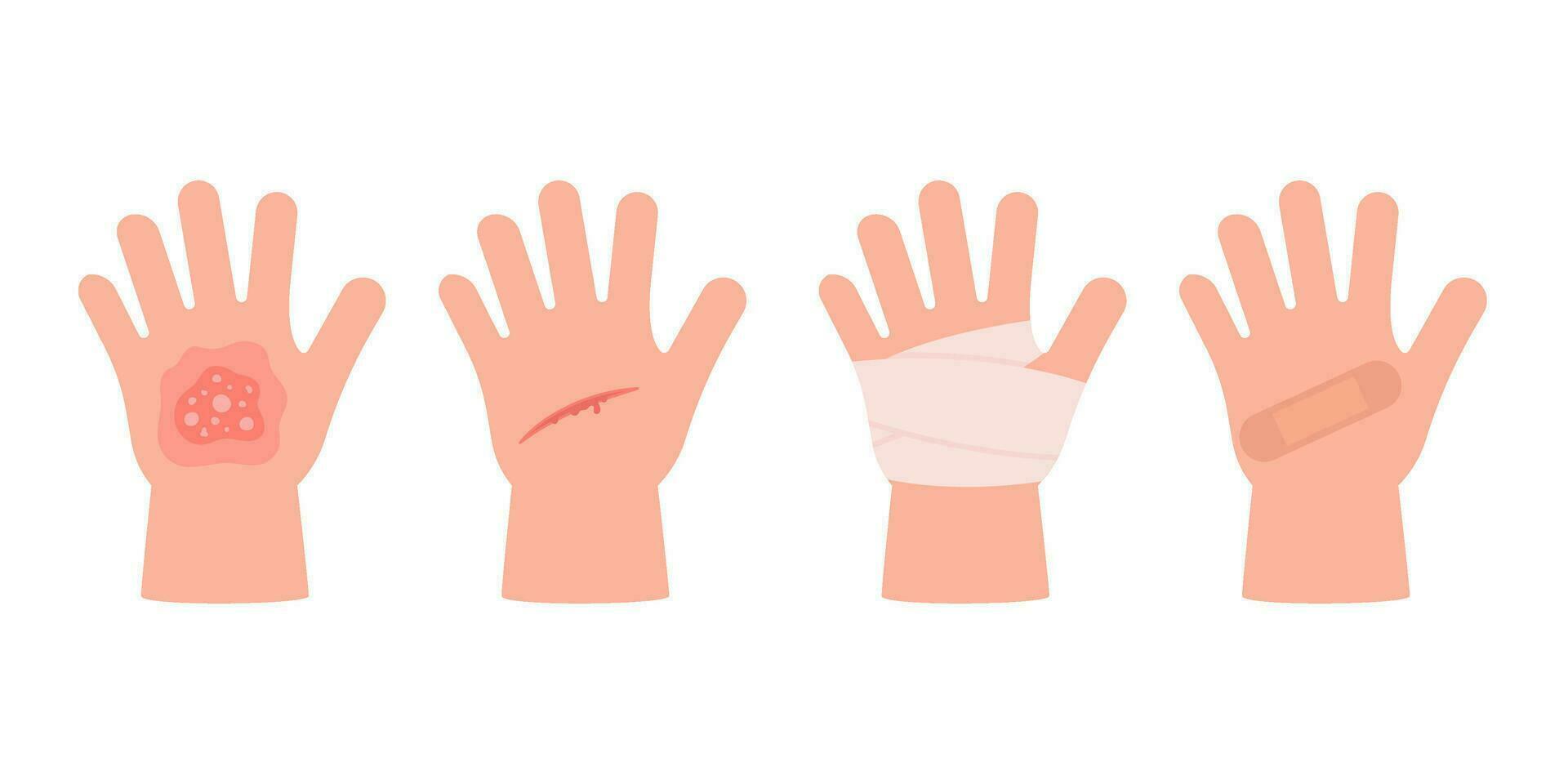 Physical injury child hand with burn of skin, open cut, bleeding wound. First aid clean bandage and patch. Vector illustration