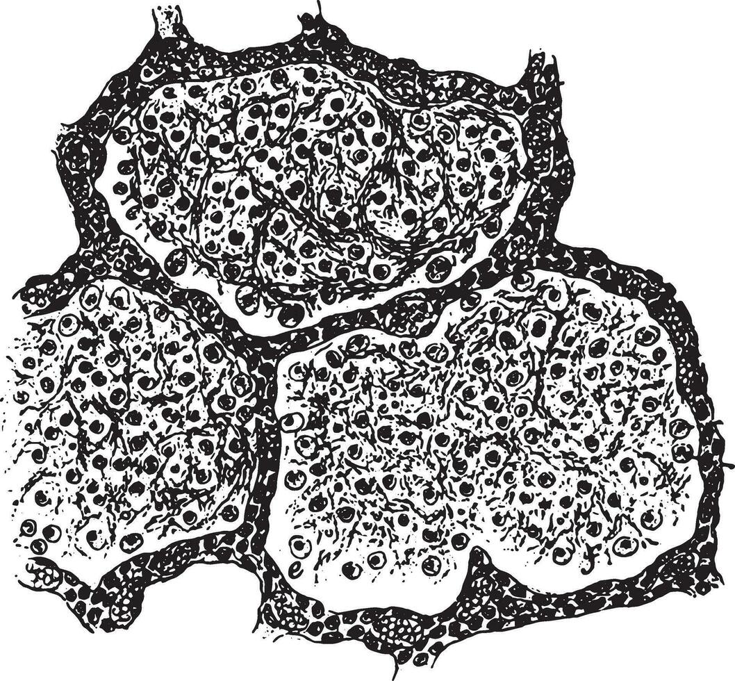 Tres alvéolos lleno con fibrinoso exudado, Clásico grabado. vector