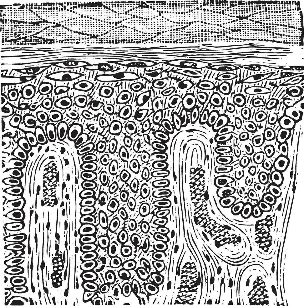 Squamous epithelioma, vintage engraving. vector