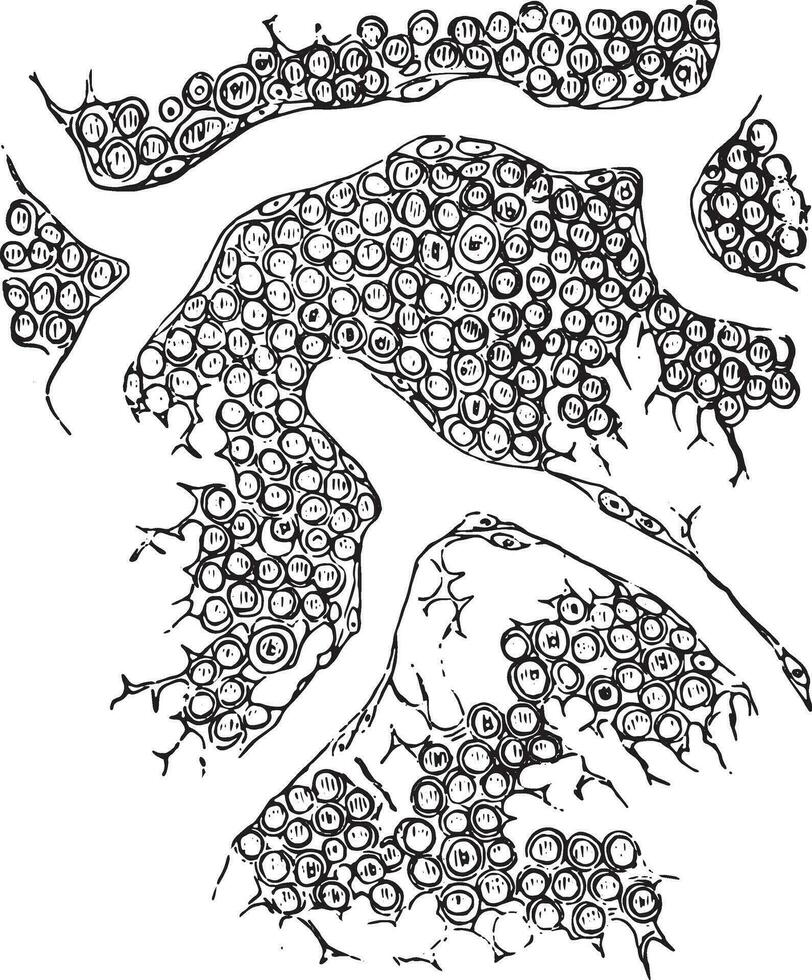 Round cell sarcoma, vintage engraving. vector