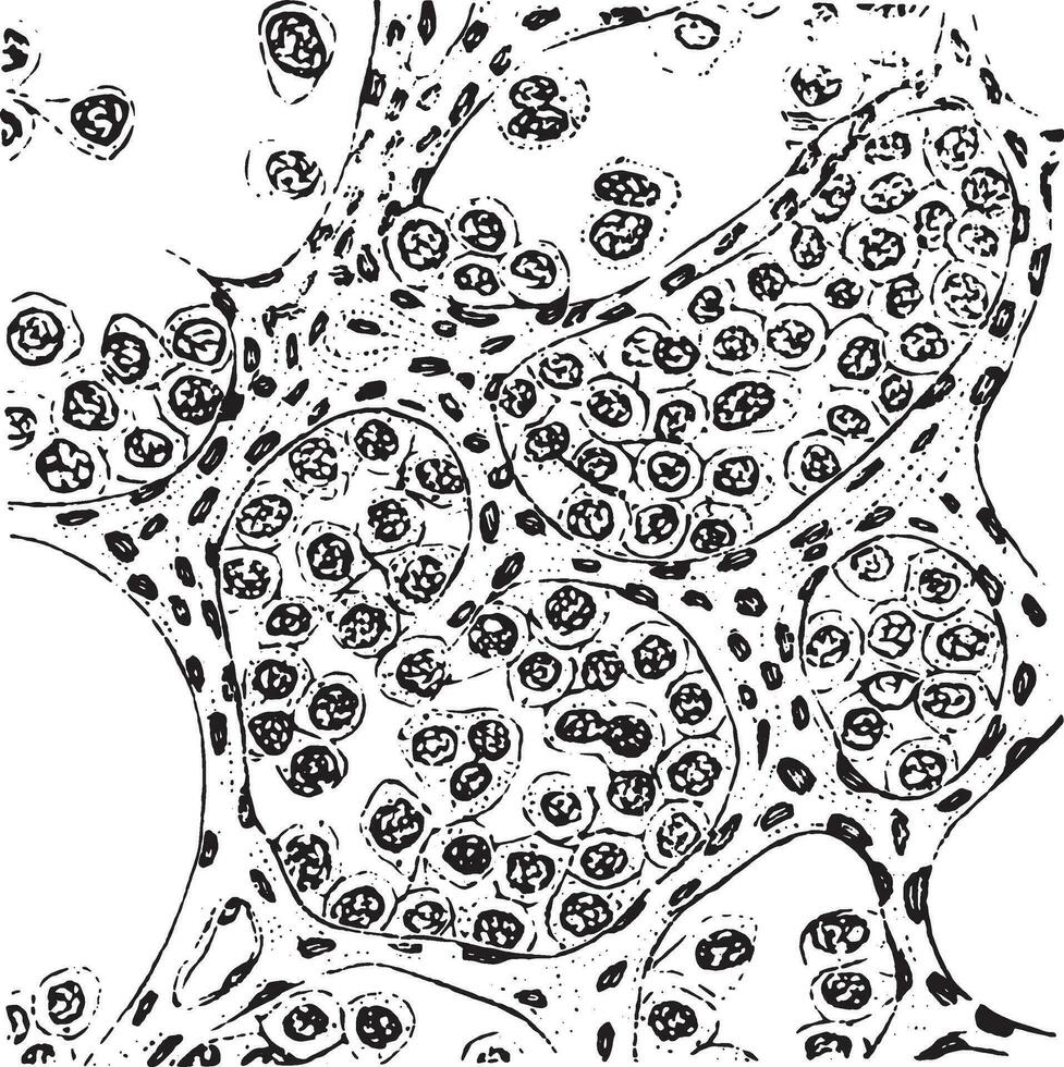 Alveolar sarcoma, vintage engraving. vector