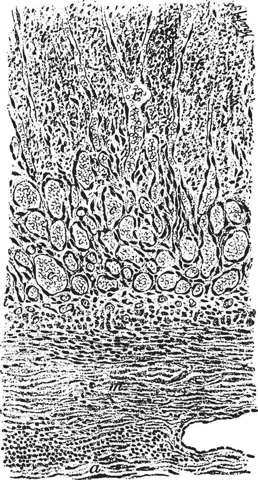 Section through a part of vein with its contained organizing thrombus, vintage engraving. vector