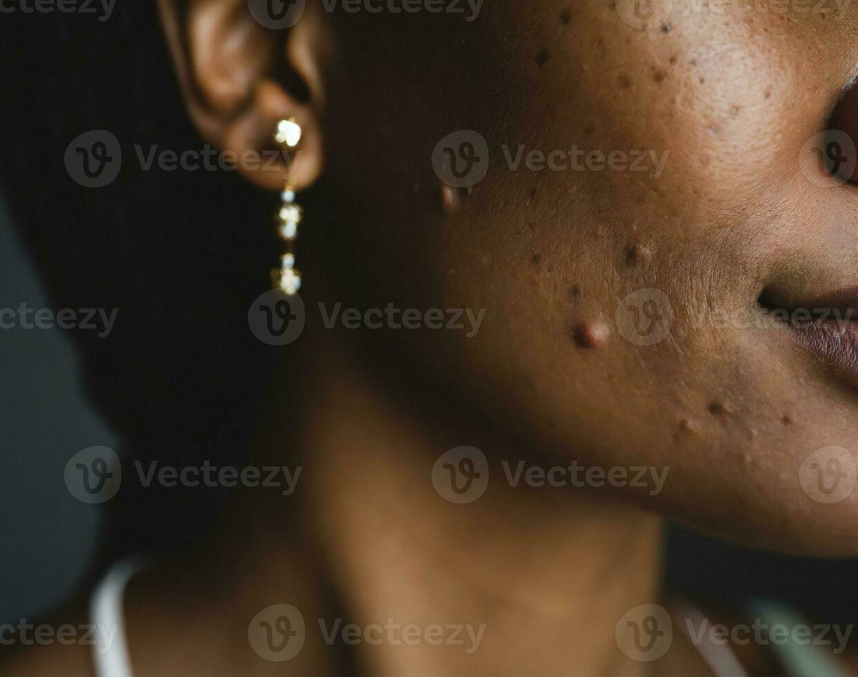 AI generated a face with pimples, blemishes and acne photo