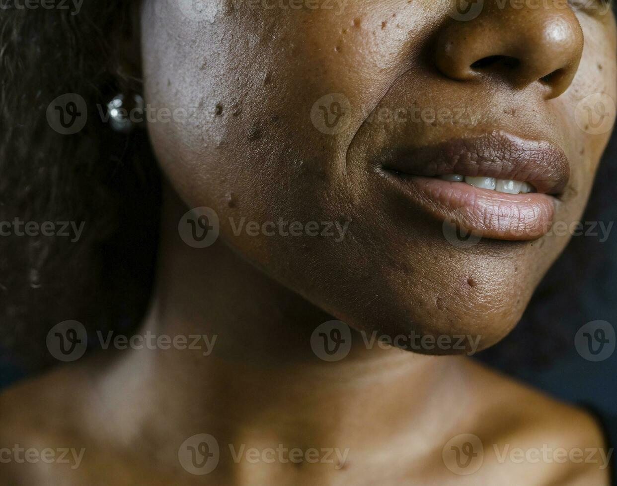 AI generated a face with pimples, blemishes and acne photo