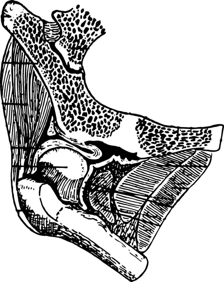 Congenital Dislocation of the Hip, vintage illustration. vector
