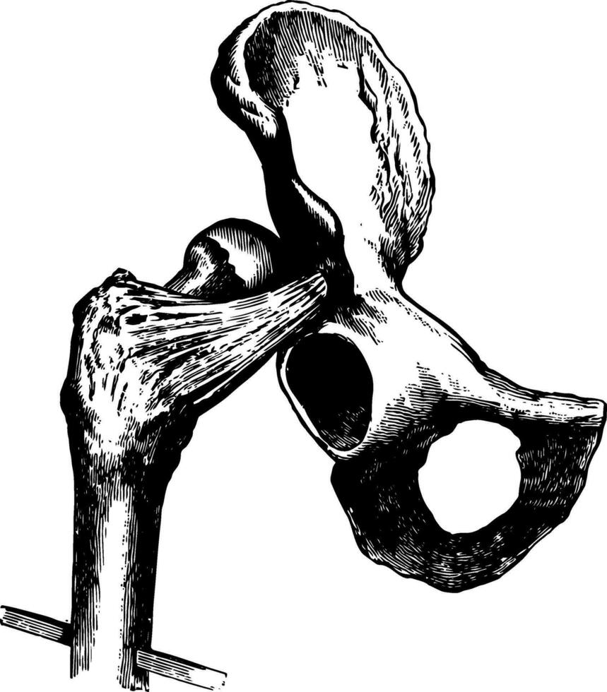 Hip Dislocation upon the Dorsum Illi, vintage illustration. vector